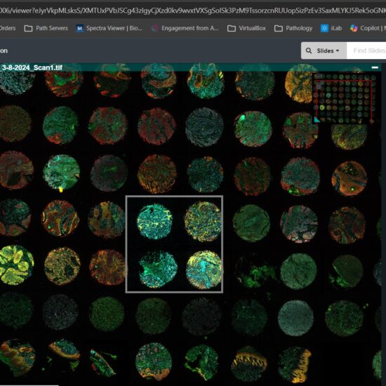 Indica Labs Halo link interface showing a fluorescent tissue microarray of skin cancer.