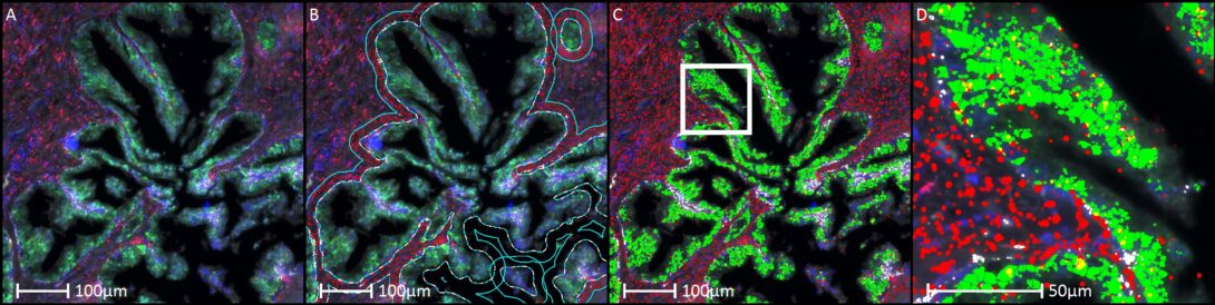 Expression of mir199, KLK3 and KRT5 in normal prostate.  Shows RNA quantification within 20um of the base of normal epithelium.