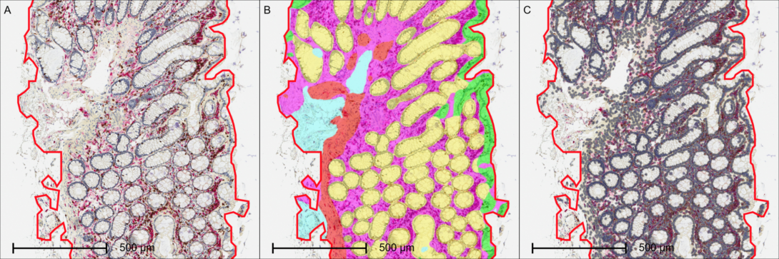 Three panel figure showing CD3 and CD163 staining in human colon biopsies with tissue compartment segmentation and marker analysis overlay.
